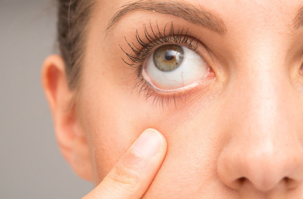 A woman holding her right eye slightly open showing the redness from dryness