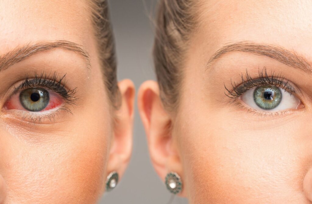 A comparison of a woman's clear eye and a woman's dry and red eye.